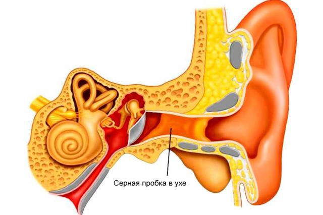 Заложенность и шум в ухе, причины и лечение заложенности в ухе без боли
