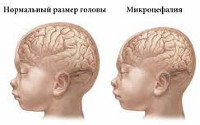Микроцефалия у детей, причины возникновения и симптомы - Неврология