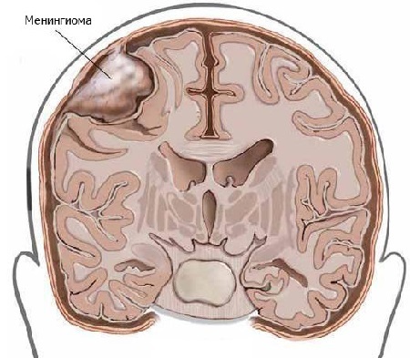 Менингиома головного мозга: прогноз жизни и лечение