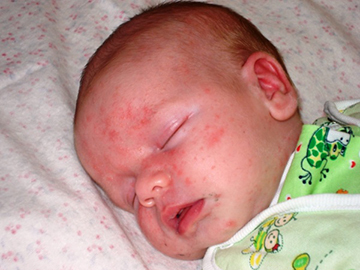 У ребенка чешется голова, шелушится кожа на голове у грудничка, новорожденного младенца, почему появилась сыпь, красные пятна, прыщики: что делать, причины зуда