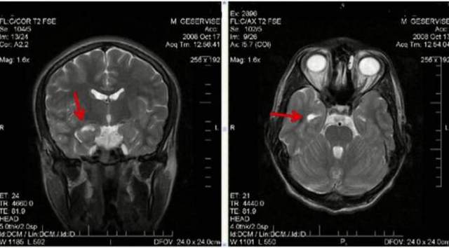 Эпилепсия: симптоматика приступа, последствия и особенности