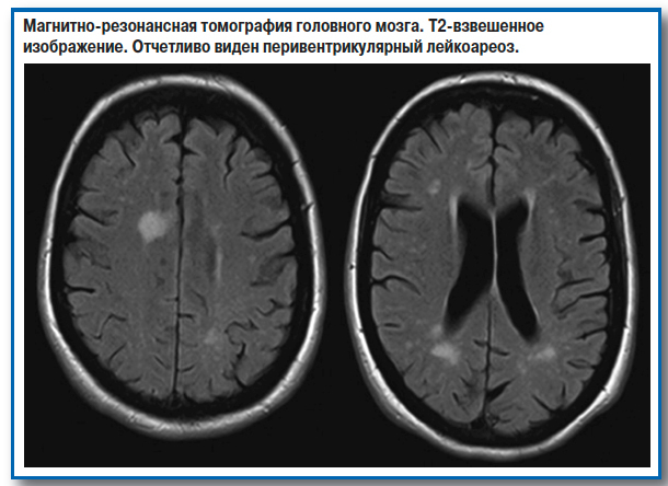 Очаговое поражение головного мозга: что это такое, очаги на МРТ, симптомы, диагностика, лечение