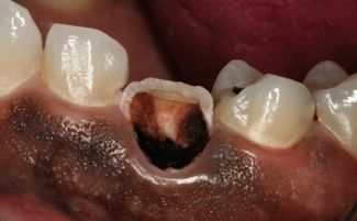 Пульпит зуба: что это такое, симптомы, методы лечения, осложнения