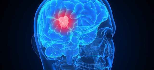 Кистозно – глиозные изменения головного мозга: что это такое?