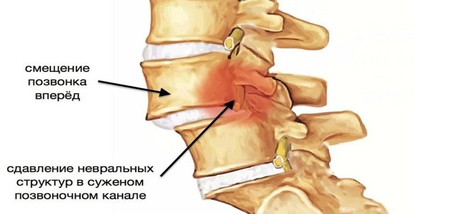 Боли в шее и плечах: причины и лечение сильной боли в мышцах