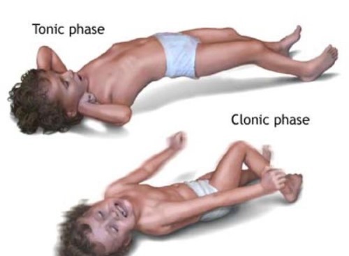 Причины развития и лечения клонических судорог