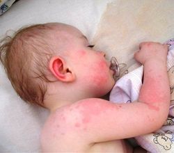 Лавровый лист от аллергии у детей: лечение отваром или настоем, отзывы