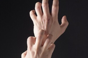 Пузырьки на пальцах рук народное лечение