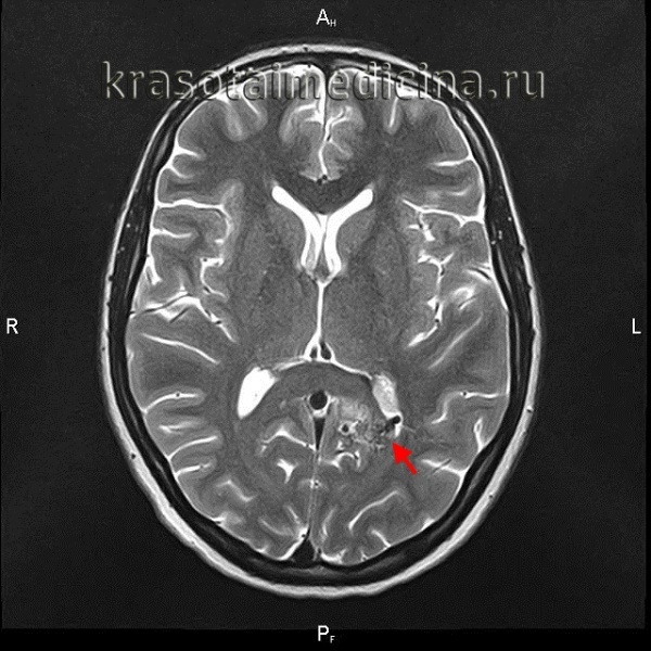 Артериовенозная мальформация сосудов головного мозга