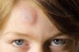 Гематома на голове после ушиба: лечение, последствия
