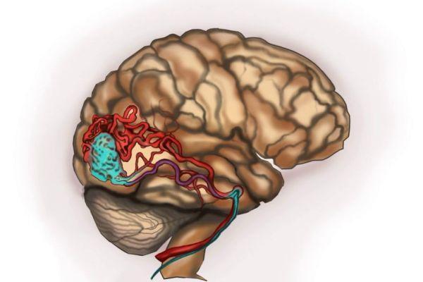 Кавернозная ангиома головного мозга: лечение, прогноз