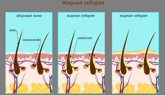 Самые эффективные способы лечения жирной себореи кожи головы
