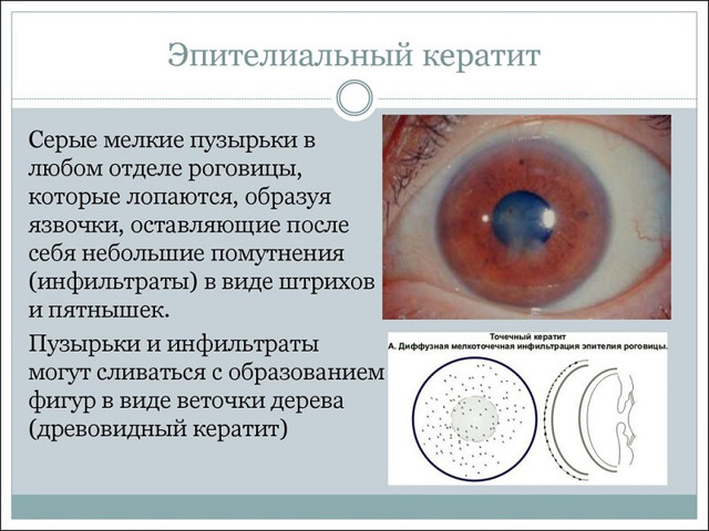 Глаза режет от компьютера: симптомы, причины и методы лечения