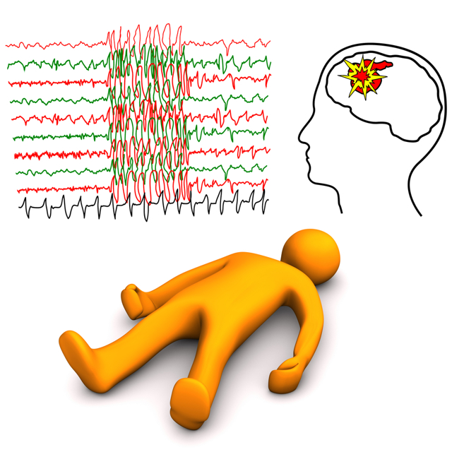Эпилептический приступ - симптомы, причины, лечение