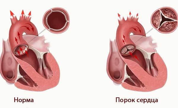 Внутренняя дрожь в теле и сердцебиение: причины и лечение