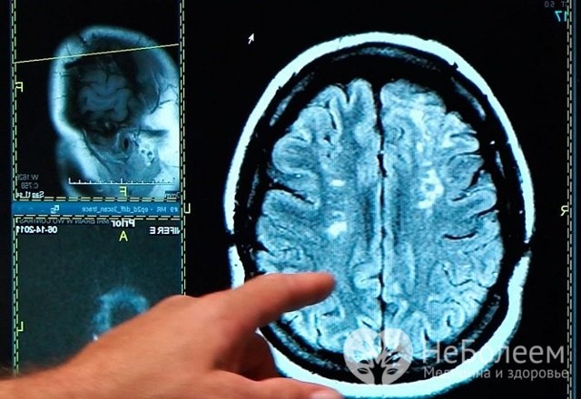 Обширный инсульт головного мозга: последствия, шансы выжить, прогноз