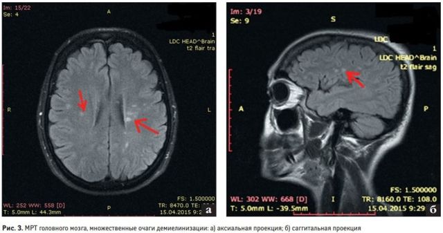 Очаговое поражение головного мозга: что это такое, очаги на МРТ, симптомы, диагностика, лечение