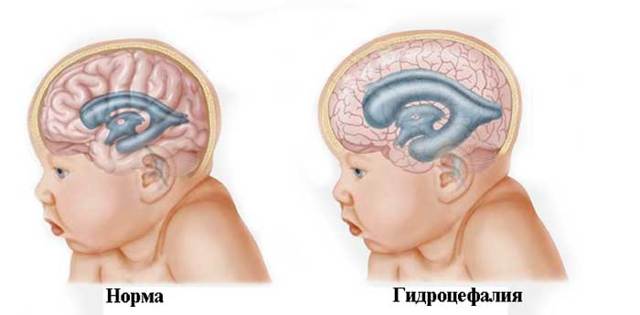 Гидроцефалия (водянка) головного мозга у взрослого: лечение