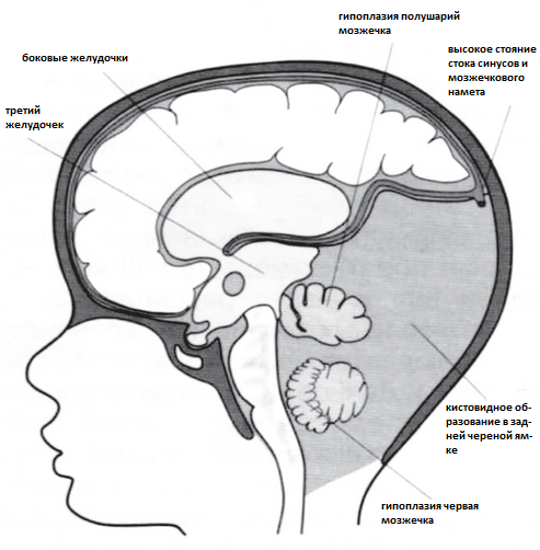 Синдром Денди Уокера (аномалия, мальформация): причины, симптомы, лечение
