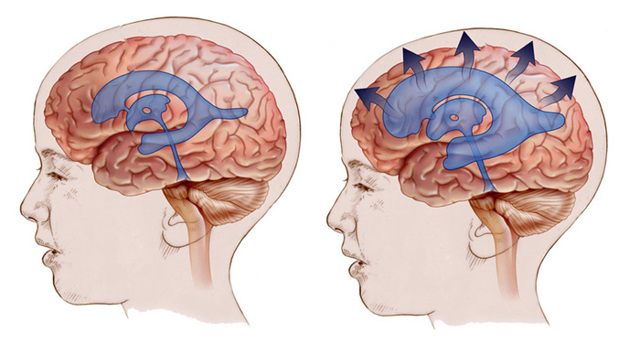 Гидроцефалия головного мозга у детей - причины, можно ли вылечить?