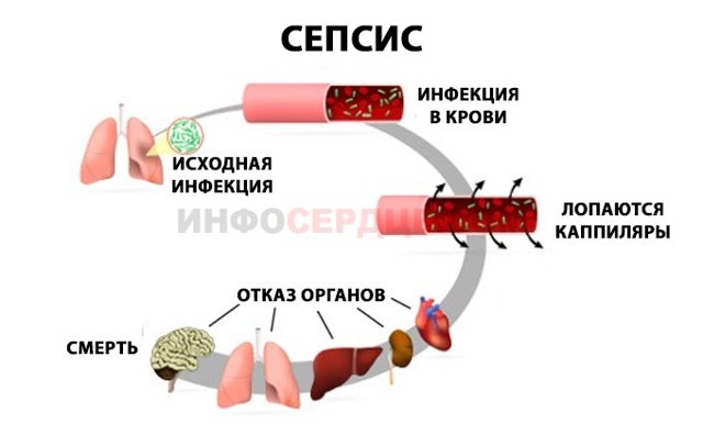 МКБ-10 Септический шок - лечение, клиника, признаки по международной классификация болезней