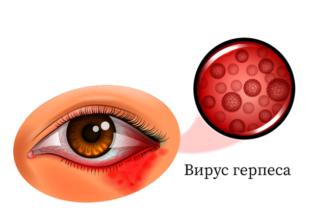 Вирусный конъюнктивит глаз: лечение у взрослых, симптомы, признаки и профилактика заболевания