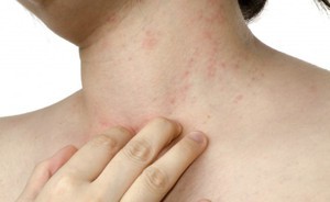 Аллергия на коже - красные пятна чешутся, лечение (фото)