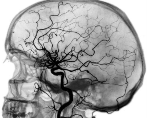 Церебральная ангиография сосудов головного мозга