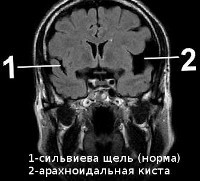 Киста головного мозга арахноидальная, ретроцеребеллярная, киста шишковидной железы, прозрачной перегородки) – симптомы
