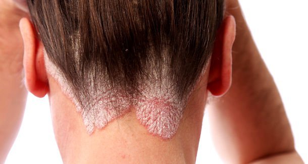 Почему может шелушится кожа головы: болезни, диагностика, лечение