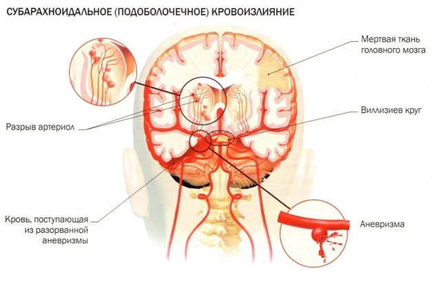 Субарахноидальное кровоизлияние в мозг: последствия, симптомы и лечение