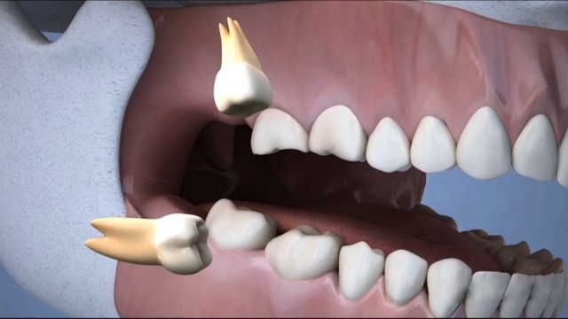 Болит зуб мудрости - лечить или удалять