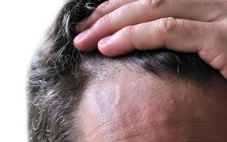 Себорейный дерматит волосистой части головы - лечение себорейного дерматита на голове у взрослых
