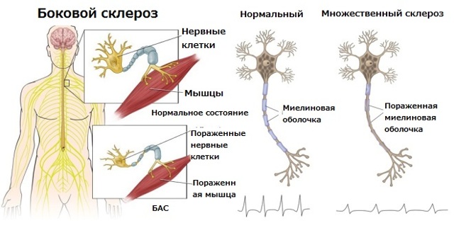 Болезнь двигательного нейрона: клиническое течение, дифференциальная диагностика и патогенетические аспекты лекарственной терапии