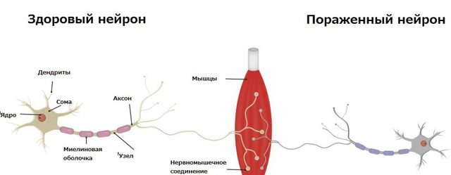 Болезнь двигательного нейрона: клиническое течение, дифференциальная диагностика и патогенетические аспекты лекарственной терапии