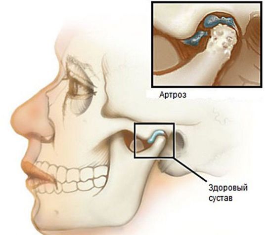 Что делать если болит челюсть возле уха при открытии рта?