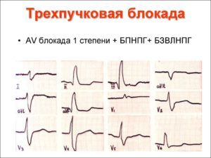 Нарушение внутрижелудочковой проводимости сердца: что это такое, лечение
