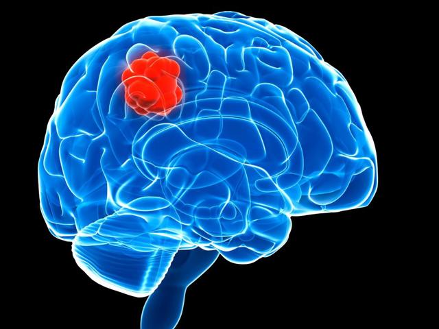 Фитотерапия при опухолях головного мозга - народная медицина