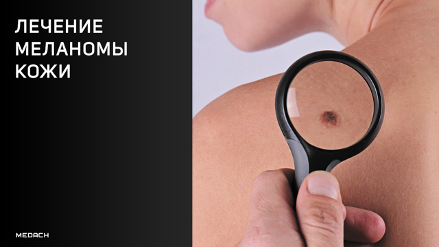 Лечение меланомы кожи: обзор различных методов