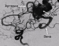 Артериовенозная мальформация сосудов головного мозга