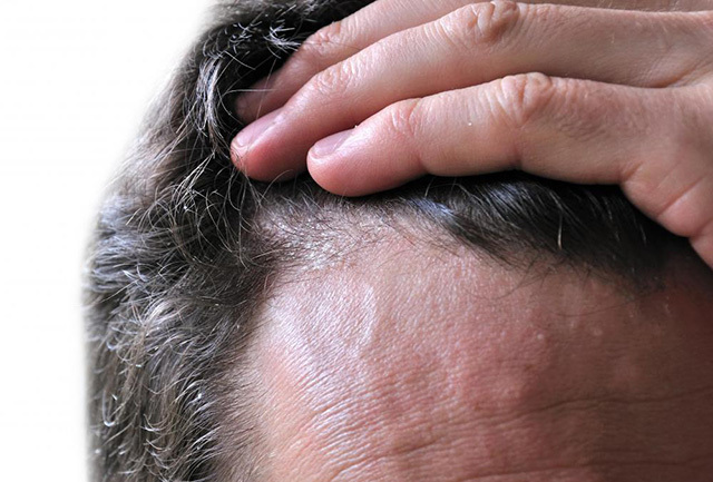 Себорейный дерматит волосистой части головы - лечение себорейного дерматита на голове у взрослых