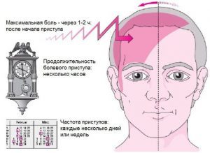 Мигрень: как снять боль, что делать при приступе