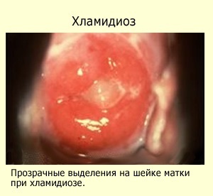 Хламидиоз у женщин - симптомы, лечение и признаки хламидий