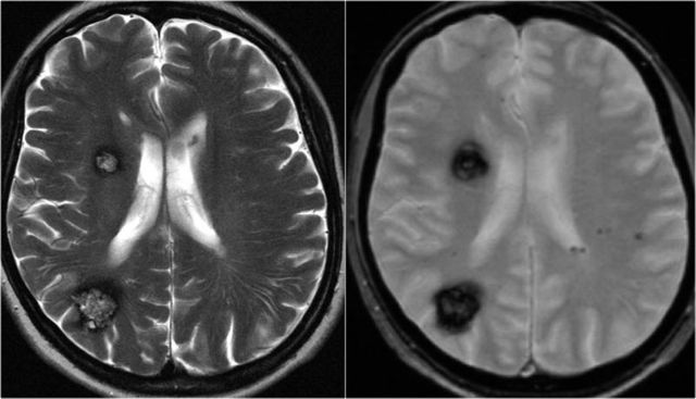 ЭЭГ или МРТ головного мозга: отличие, что лучше?