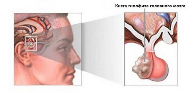 Чем опасна киста головного мозга в пожилом возрасте: головные боли и судороги