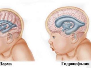 Гидроцефалия головного мозга у детей - симптомы гидроцефалии у грудных и новорожденных детей, лечение и последствия