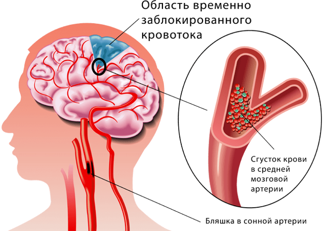 Нарушение мозгового кровообращения: симптомы и лечение