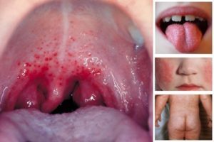 Почему чешется горло и уши внутри и появляется кашель - инфекционные причины, заболевания внутренних органов, аллергия