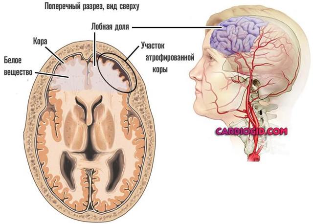 Атрофия мозжечка головного мозга: симптомы, лечение, последствия