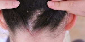 Грибок кожи головы: симптомы и лечение (фото)